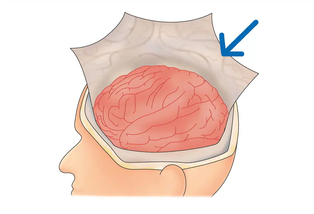 Tensione della dura madre
